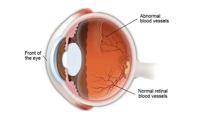 Retinopathy of Prematurity
